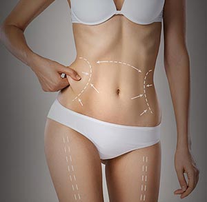 Liposuction at Kureshi Medspa in McKinney, TX